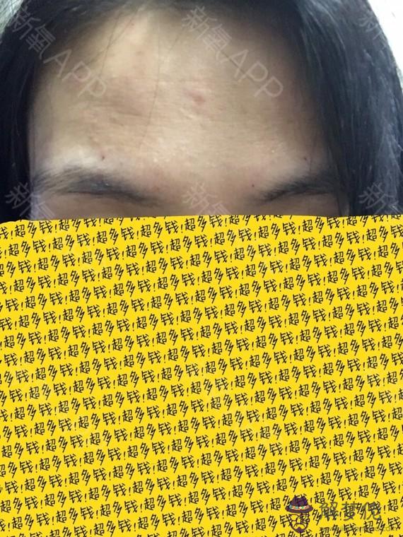 如何去除抬頭紋:如何去除抬頭紋