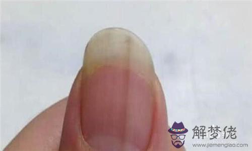 手指蓋有豎紋怎麼回事:手指甲上有一條條的豎紋是什麼病的征兆嗎？